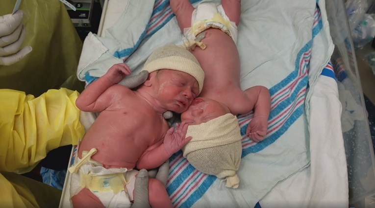 Nerazdvojni od rođenja: Blizanci tješili jedan drugog nakon poroda