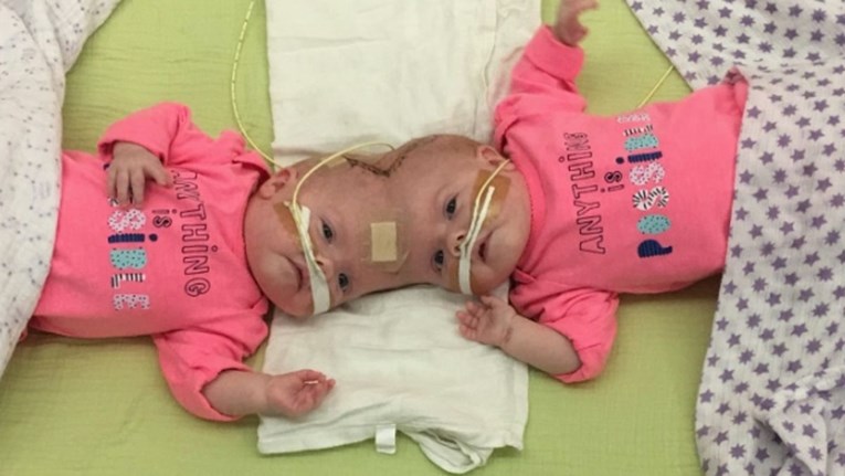 Rođene su spojenih glava: Liječnici su sumnjali da će preživjeti, ali one su se izborile