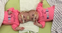 Rođene su spojenih glava: Liječnici su sumnjali da će preživjeti, ali one su se izborile