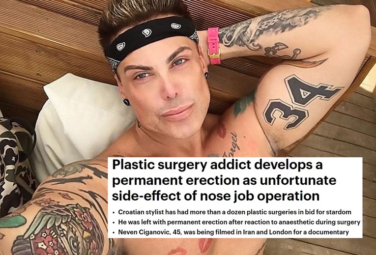Daily Mail se raspisao o bolnoj erekciji Nevena Ciganovića nakon operacije nosa