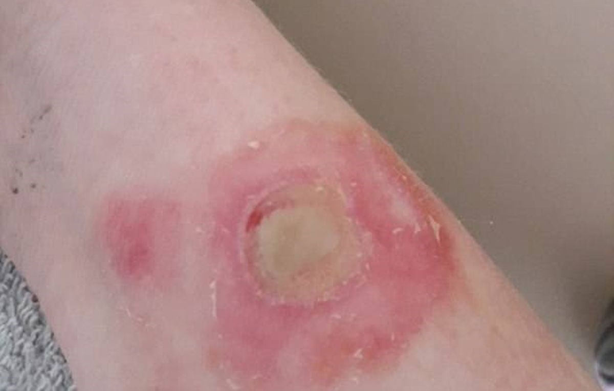 Zbog opasnog izazova koji se širi internetom ova djevojčica će trebati presađivanje kože