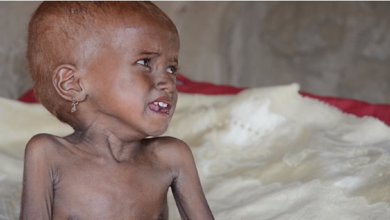 UZNEMIRUJUĆA SNIMKA Glad i kolera u Jemenu: "Više od 50 tisuća djece umrijet će do kraja godine"