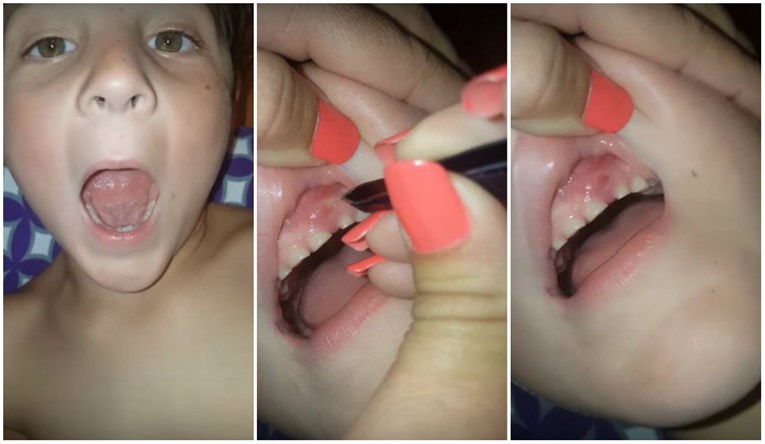 Odvratan video pokazuje na što liče usta djeteta koje grize nokte