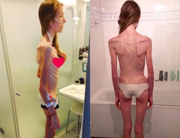 Šokantne fotke borbe s anoreksijom: "Imala sam 30 kilograma, dani su me dijelili od smrti"