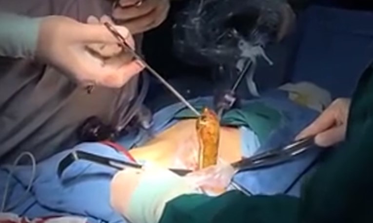 VIDEO Pijanog ga zaprimili u bolnicu pa shvatili da je u anus ugurao nešto stvarno odvratno