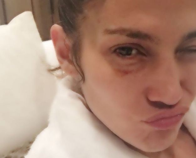 FOTO Nakon puse bivšem, Jennifer Lopez šokirala obožavatelje masnicom ispod oka