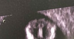 Ne može se baš puno mama pohvaliti ovako strašnom fotografijom s ultrazvuka