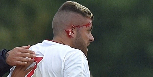 Krvav debi: Francuskom napadaču kopačkom odrezao komad uha