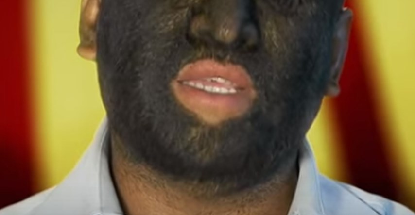 VIDEO Upoznajte najdlakavijeg čovjeka na svijetu kojem je 98 posto tijela prekriveno gustim dlakama