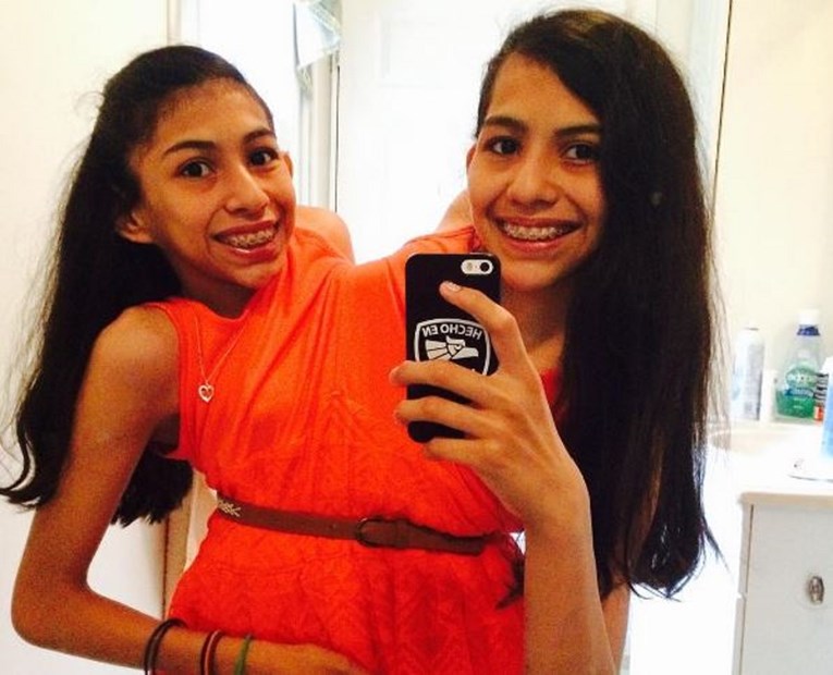 FOTO Sijamske blizanke spojene su 16 godina i unatoč problemima ne žele da ih razdvoje