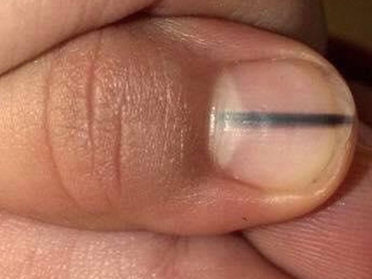 Ne ignorirajte ovakve pojave na noktima, to može biti znak teške bolesti