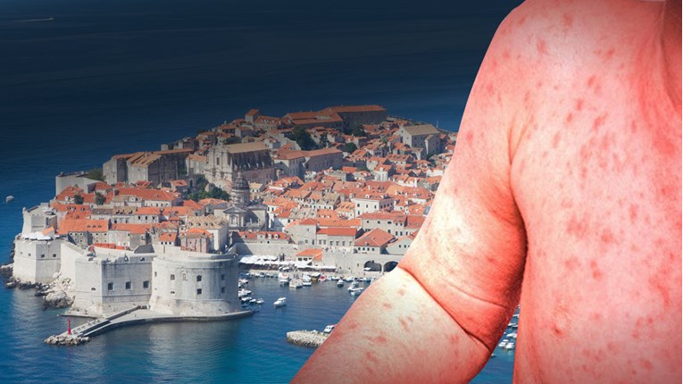 Dubrovniku prijeti epidemija ospica
