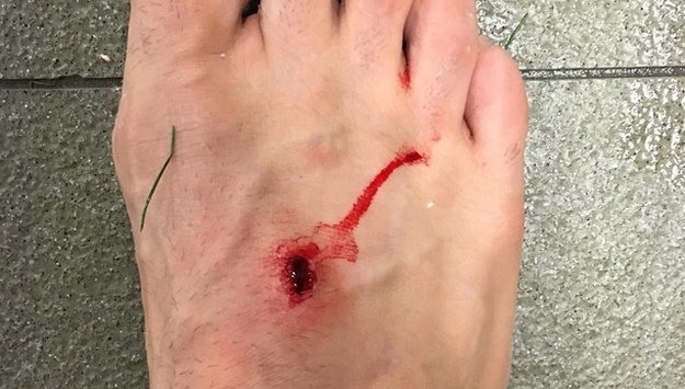 Luis Suarez više ne grize, ali sad gazi: Filipe Luis objavio fotografiju krvave noge
