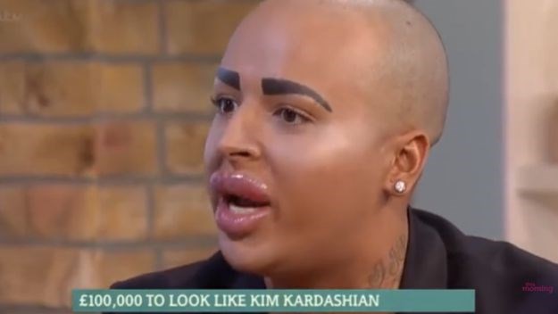 Tip koji želi izgledati kao Kim Kardashian: Bez ovih usnica bio bih normalan i dosadan!