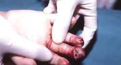 Baka dala petardu unučici koja ima 1,5 godinu, eksplodirala joj u ruci i otkinula dio šake i dva prsta