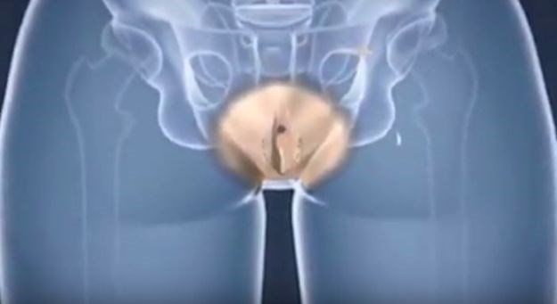 Detaljan video: Evo kako izgleda operacija promjene spola