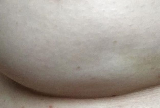 Ova fotografija prikazuje simptom raka na koji često ne obraćamo pažnju