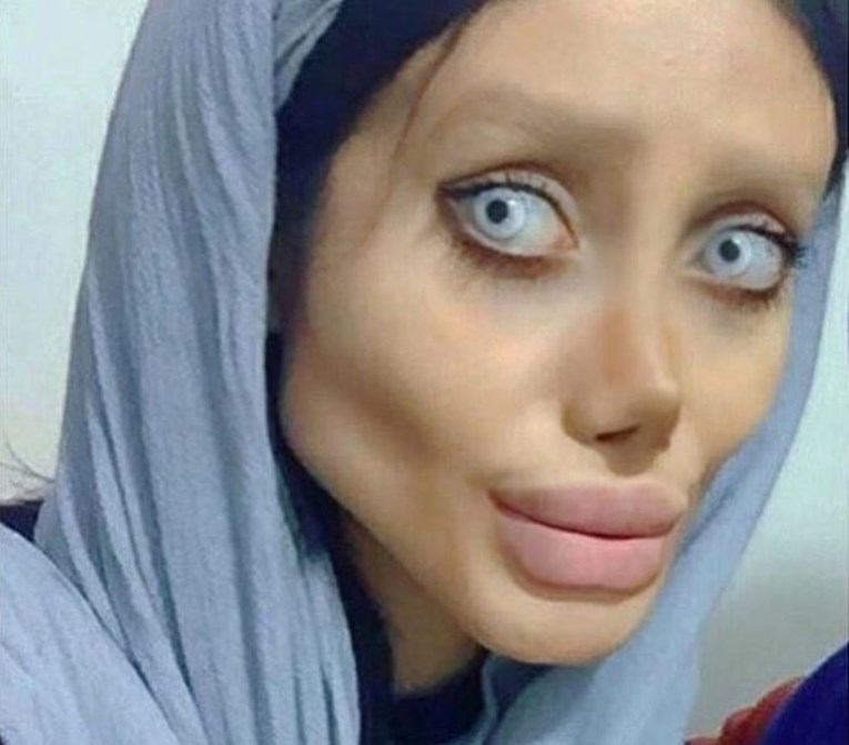 FOTO Izoperirala se da izgleda kao Angelina Jolie, no ispalo je jezivo: "Ista si Mrtva mladenka"