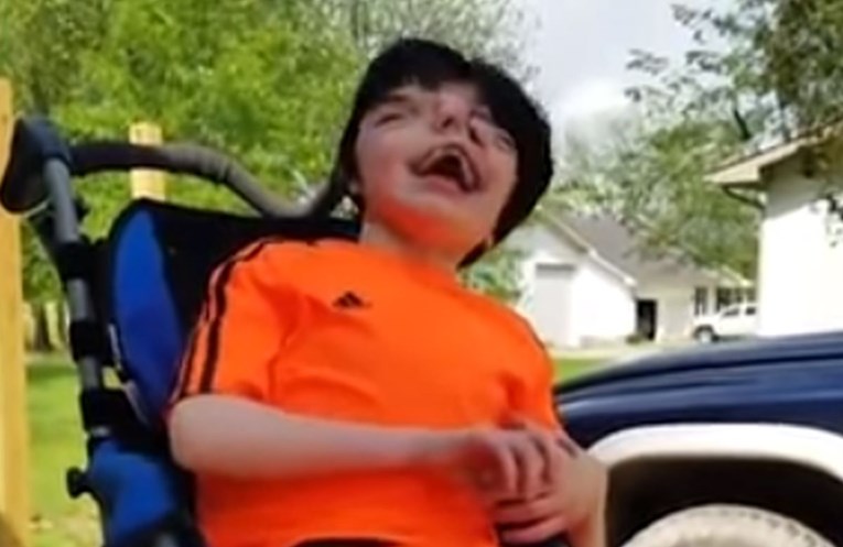 VIDEO Dječak s dva lica od kojeg su liječnici digli ruke proslavio je 13. rođendan