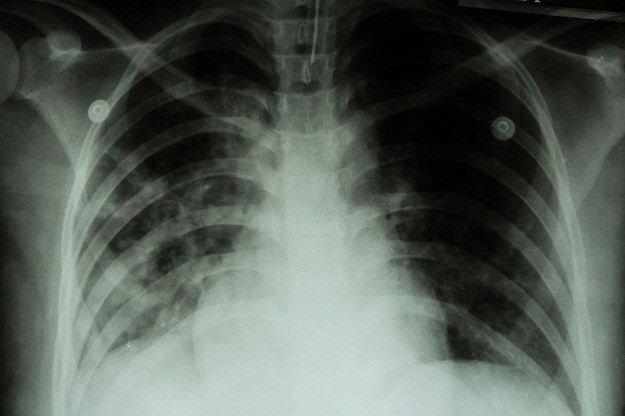 Liječnici u panici: U Švicarskoj pacijent obolio od tuberkuloze otporne na 7 različitih antibiotika
