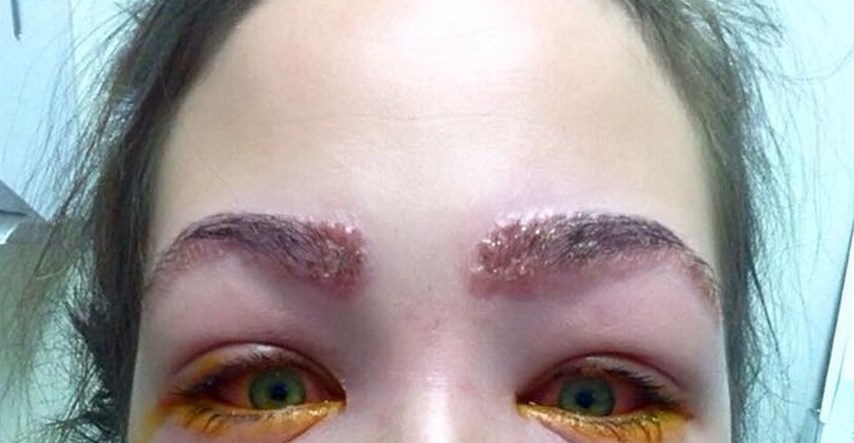 Fotke koje će vas užasnuti: Skoro je oslijepila zbog alergijske reakcije na šminku