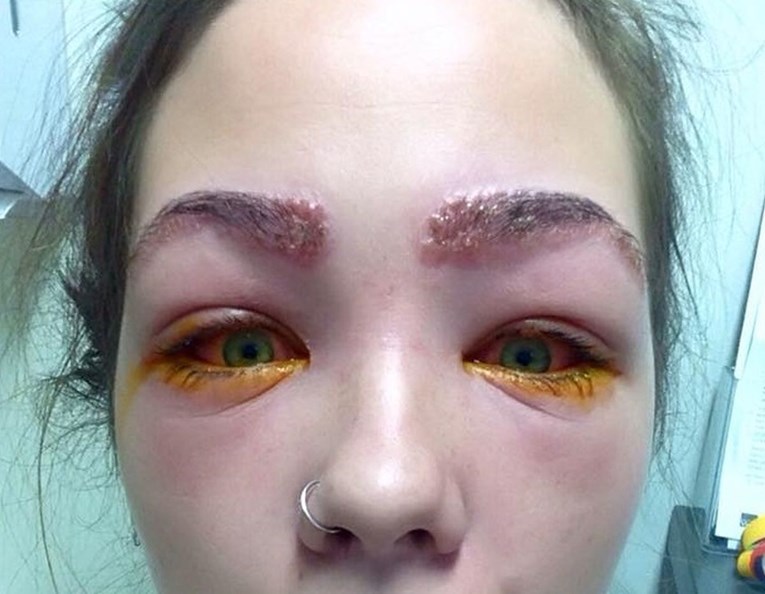 Fotke koje će vas užasnuti: Skoro je oslijepila zbog alergijske reakcije na šminku