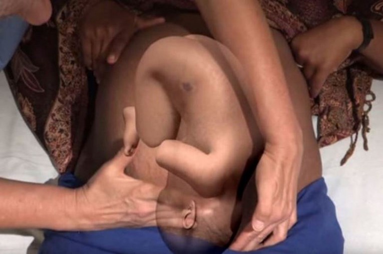 Liječnici okreću bebu okrenutu na zadak dok je još u trbuhu