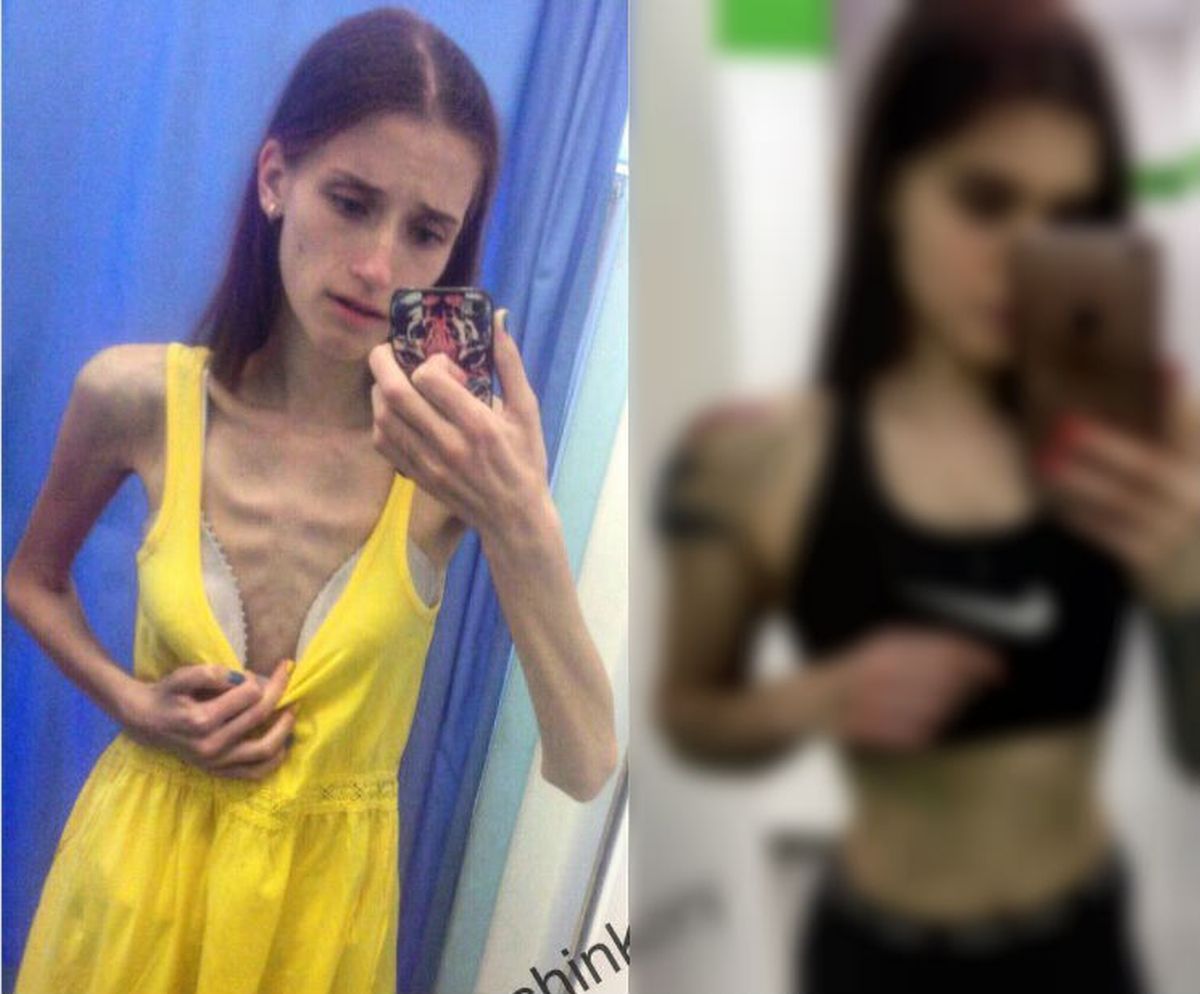Pobijedila anoreksiju: Imala je samo 33 kg, a onda se udebljala - danas je nitko ne prepoznaje