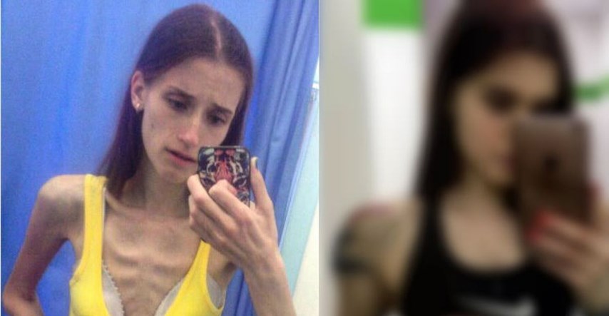 Pobijedila anoreksiju: Imala je samo 33 kg, a onda se udebljala - danas je nitko ne prepoznaje