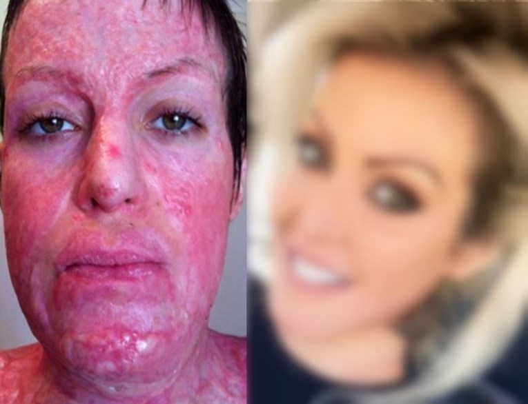 FOTO Ljubomorna žena je zapalila i uništila joj lice i tijelo, a ona danas izgleda nevjerojatno