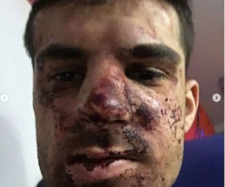 UZNEMIRUJUĆA FOTOGRAFIJA Teško pretučen nogometaš Zenita, lice mu je izobličeno