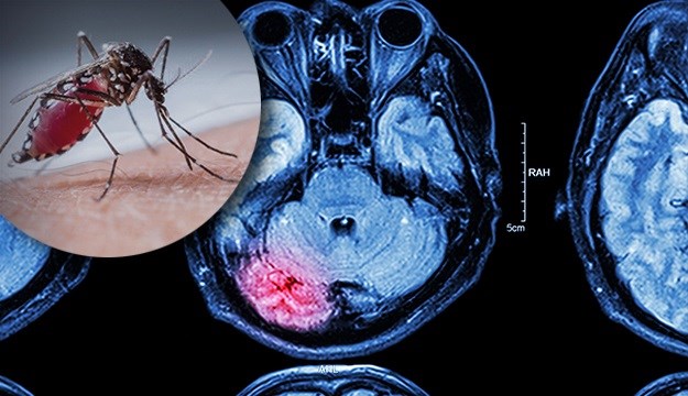 Istraživanje: Zika može ući u mozak odraslih osoba i razoriti ga