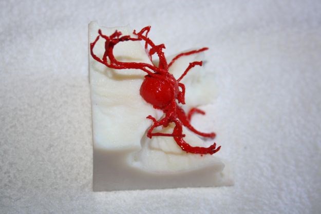 FOTO Prvi put na svijetu: U riječkom KBC-u korišten 3D model krvnih žila mozga