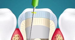 VIDEO Evo što vam zubar doista radi dok vam popravlja zub