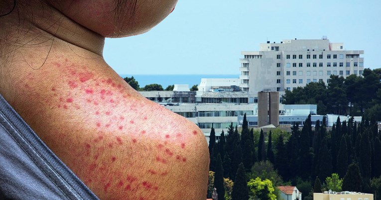 POTVRĐENO Pacijent iz Dubrovnika ima ospice: "Ne možemo isključiti mogućnost da je nekoga zarazio"