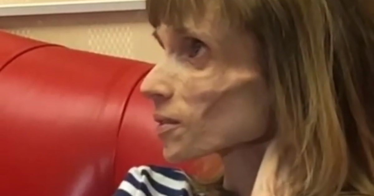 Ima samo 17 kila: Doktor joj je rekao da može glumiti živog mrtvaca u hororima