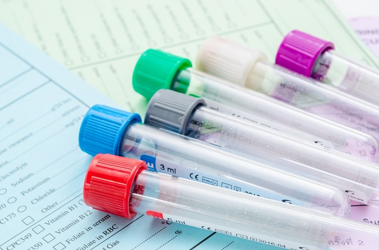 Znanstvenici razvili prvi krvni test za otkrivanje melanoma