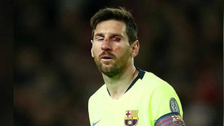 Messijeva ozljeda izgleda gadno: Je li mu se oko inficiralo?
