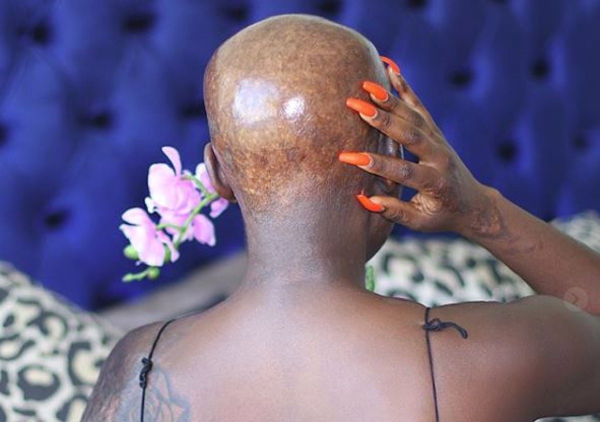 S devet godina izgorjelo joj lice, danas je beauty inspiracija curama diljem svijeta