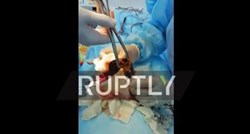VIDEO Djevojčici operacijom uklonjeno 3,5 kg dlaka iz trbuha