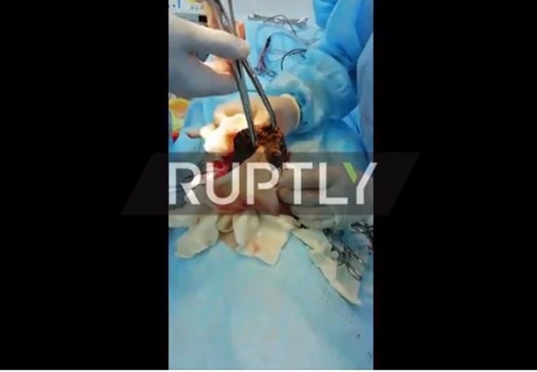 VIDEO Djevojčici operacijom uklonjeno 3,5 kg dlaka iz trbuha