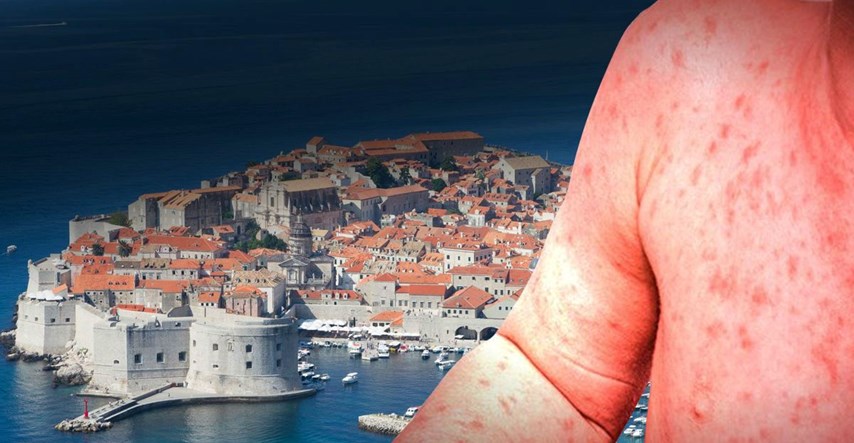 Malo dobrih vijesti iz Dubrovnika, treći dan za redom nema novih slučajeva ospica