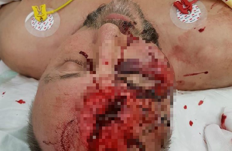 UZNEMIRUJUĆE Političar AfD-a pretučen palicama, zadobio teške ozljede glave
