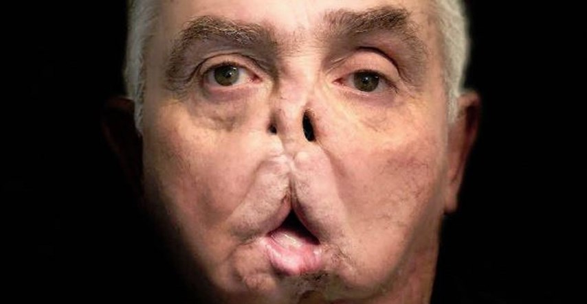 65-godišnjak postao najstarija osoba s presađenim licem, pogledajte kako izgleda