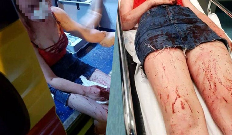 UZNEMIRUJUĆE Kreten brutalno prebio tinejdžerku u Zadru, ona objavila potresne fotografije