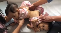 Sijamske blizanke spojene trbuhom stigle u Australiju na operaciju