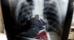 WHO: Prošle godine od tuberkuloze oboljelo 10 milijuna ljudi