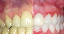 Jesu li zdraviji zubi s lijeve ili desne strane? Odgovor bi vas mogao iznenaditi