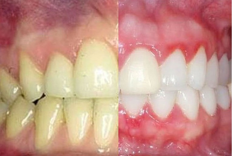 Jesu li zdraviji zubi s lijeve ili desne strane? Odgovor bi vas mogao iznenaditi