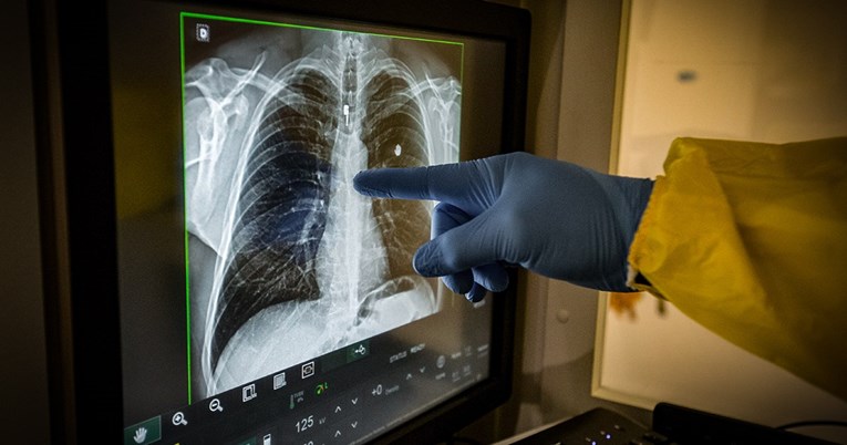 Nova studija: Velik broj zaraženih ima dugi covid. Što je to i što mogu poduzeti?